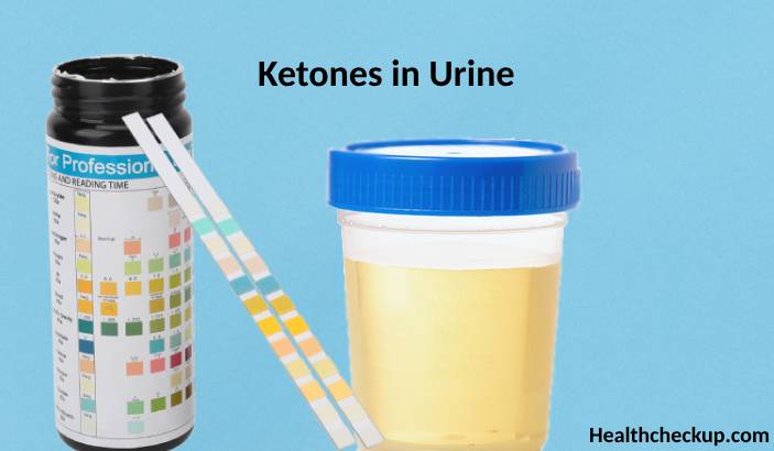 Ketones in Urine: Purpose, Preparation, Procedure, Risks, Results
