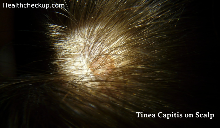 Tinea Capitis