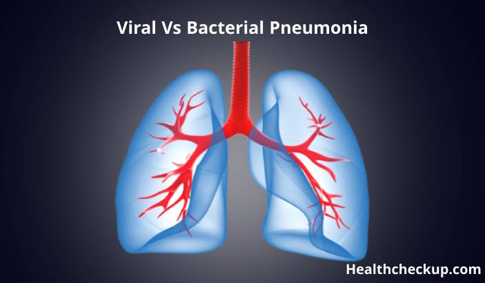 Is Pneumonia Viral or Bacterial?e occurs.