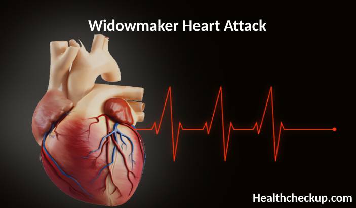 Widowmaker Heart Attack - What is it? Survival Rate, Symptoms, Prevention
