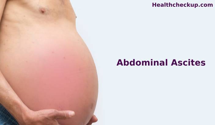 Abdominal Ascites: Definition, Symptoms, Causes, Treatment